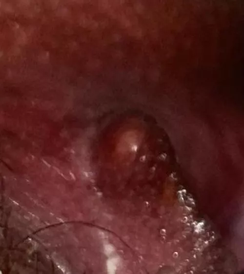 It felt like I had torn my labia, imagine my surprise when I found this thing! Wasn’t sure what it was, so of course I squeezed it and it EXPLODED. Of course I also wasn’t recording because I’m an idjit!