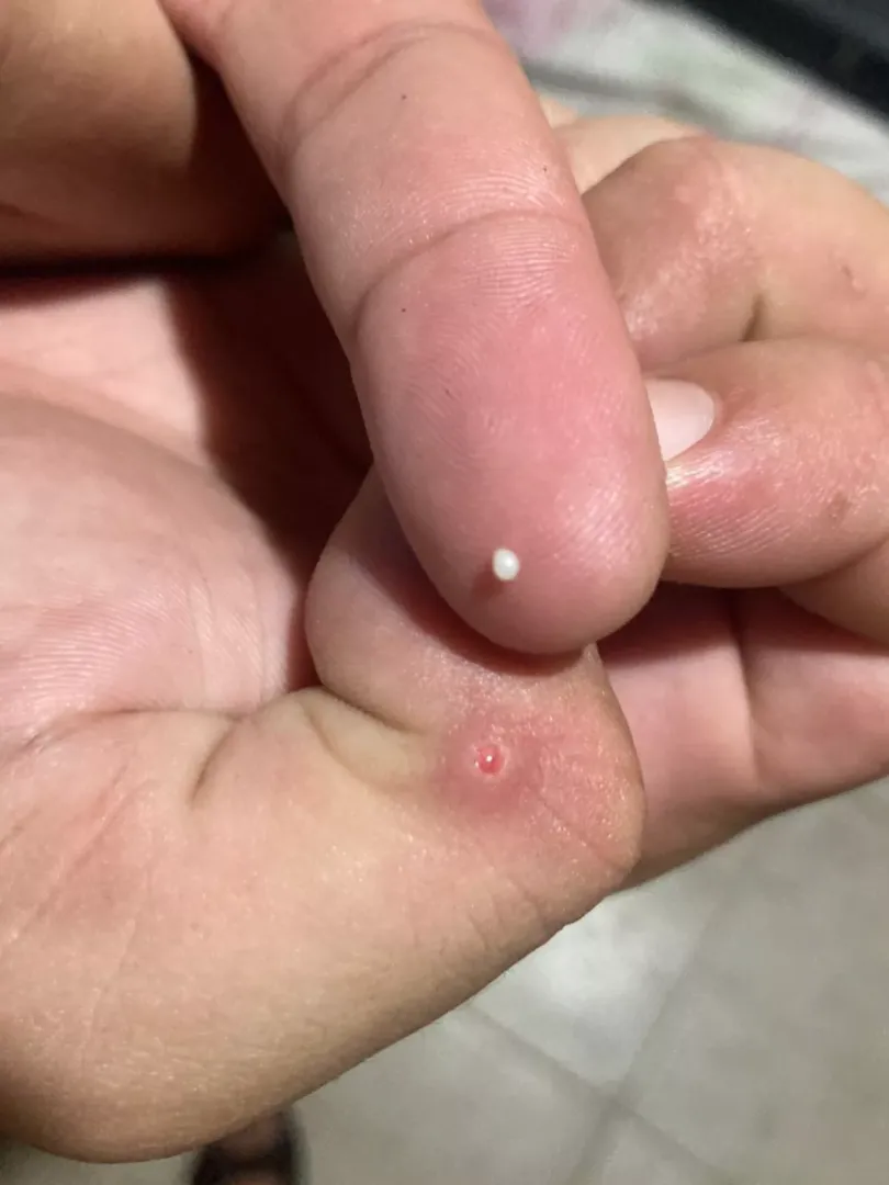 It grows once a year in the same spot under my skin and i have to cut and remove. What is this thing?