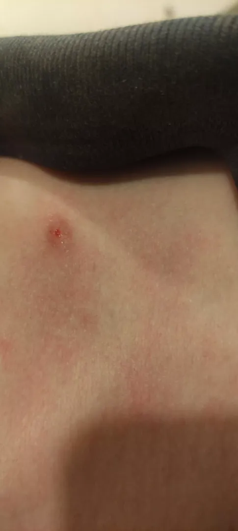 It's a little gaper... Pimple/milia/cyst idk which that's been annoying me for a while. Finally found my tweezers and was able to pull out what looked like the sac or a two-headed milia. Unfortunately, I lost what I pulled out before I could take a pic