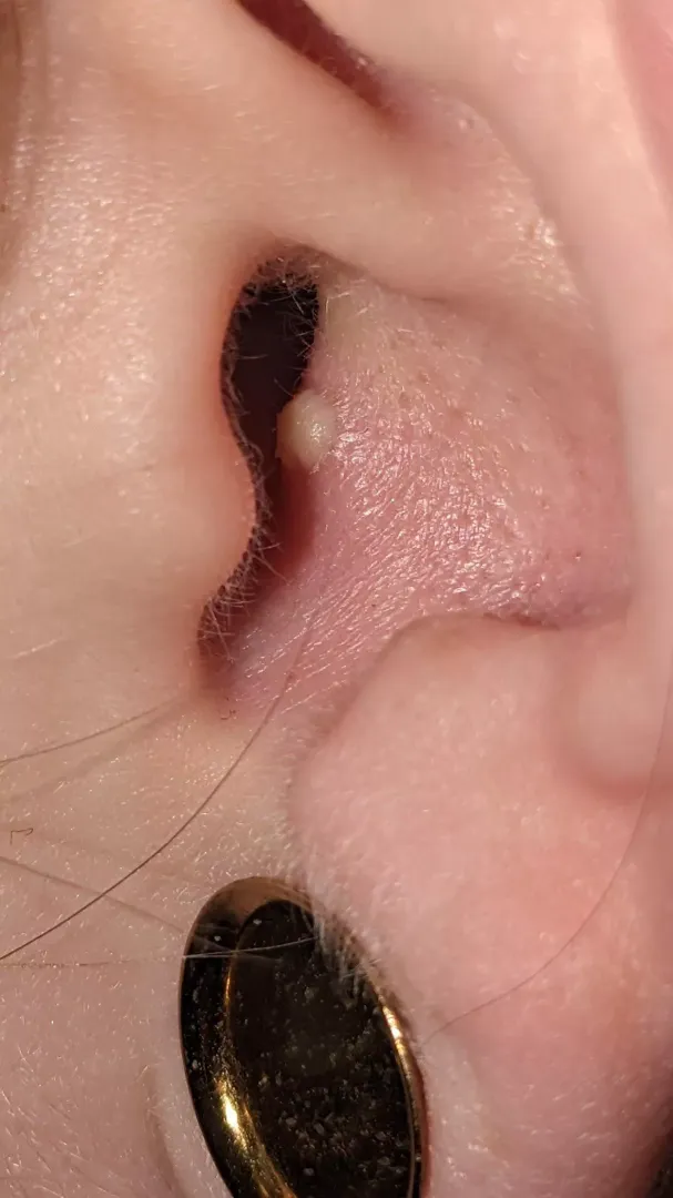 I’ve never had an ear pimple before I hate it