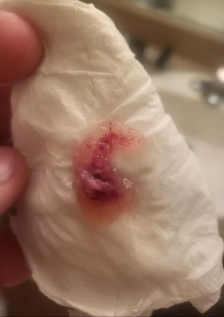 Just blew this out of my nose, am I gonna die ☠️