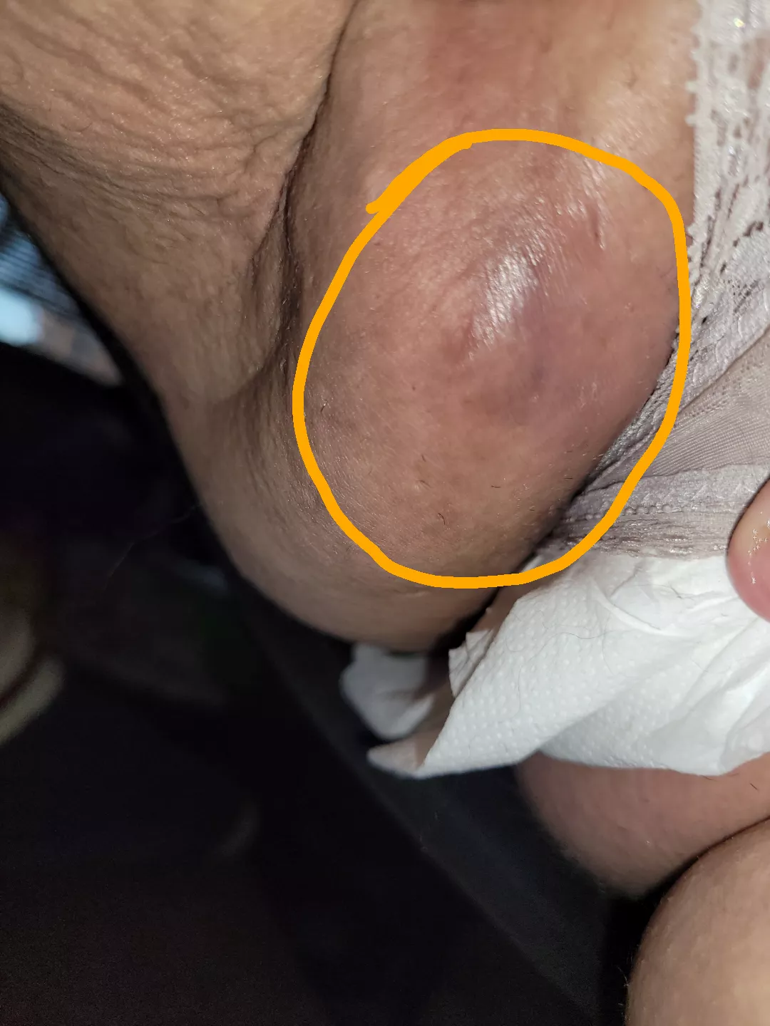 Large strep b boil/abcess on vagina. It has ruptured on its own and I am on medicine to get rid of the infection. It was caused by a high blood sugar for a prolonged period of time.