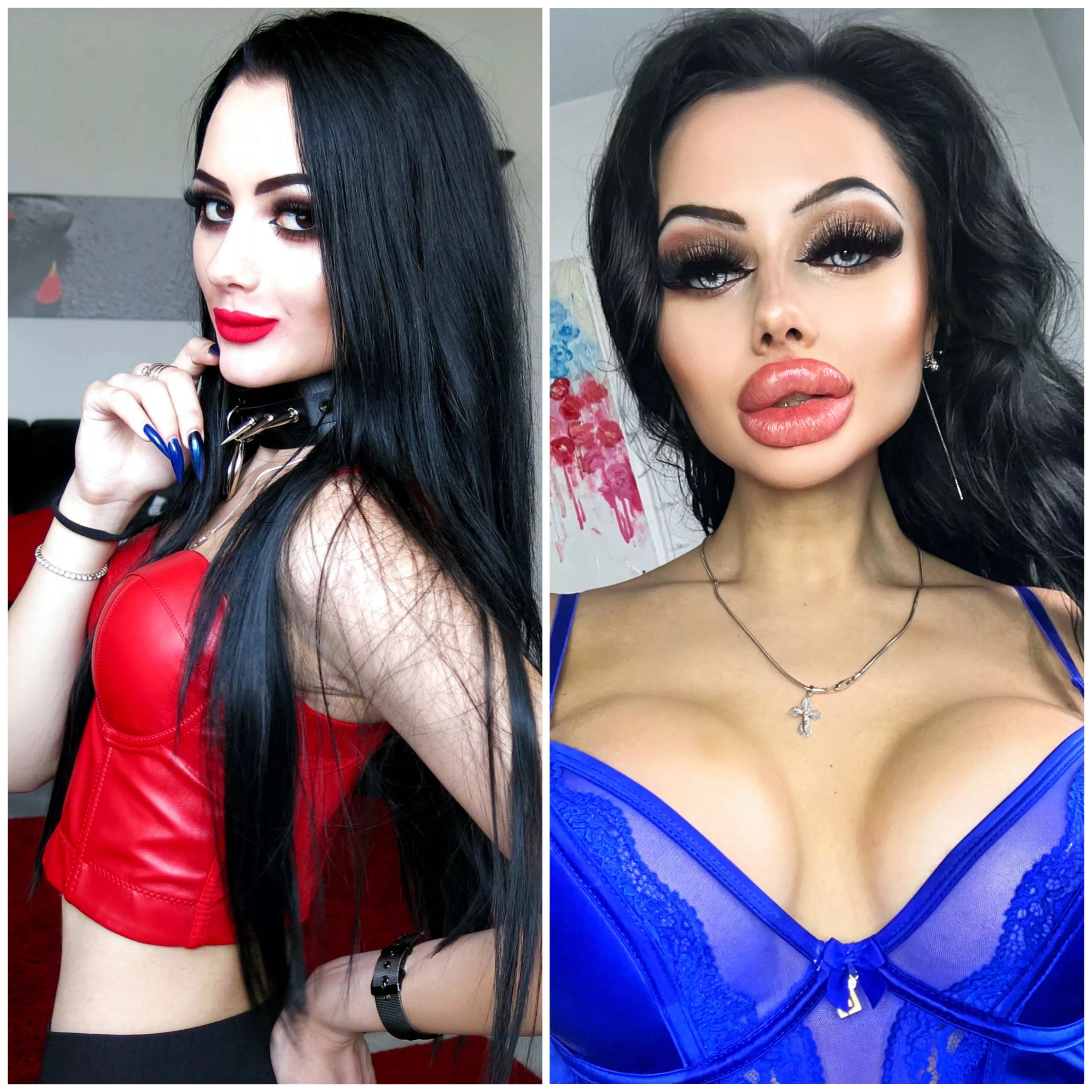 Left photo - 18 y.o., Lips 1 cc. Right one - 21 y.o., lips - 25 cc., Breast - 400 cc.