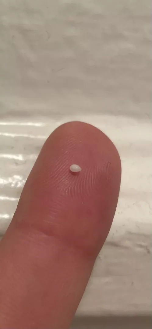 Little pearl emerged from a spot on my leg where I had a small cyst years ago
