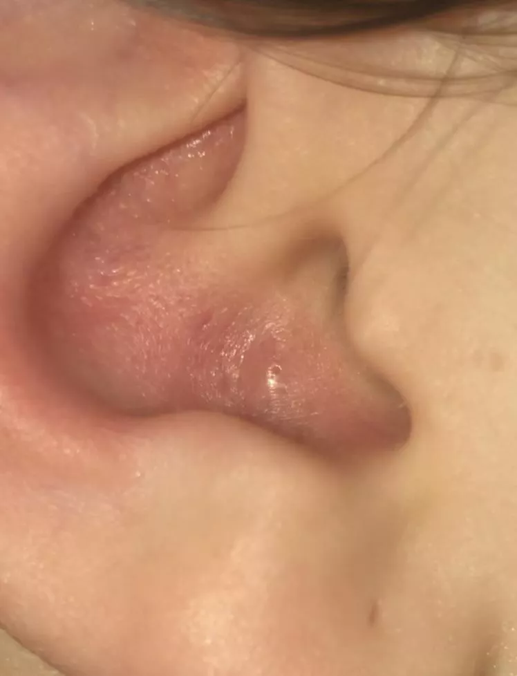 mega painful pimple in my ear