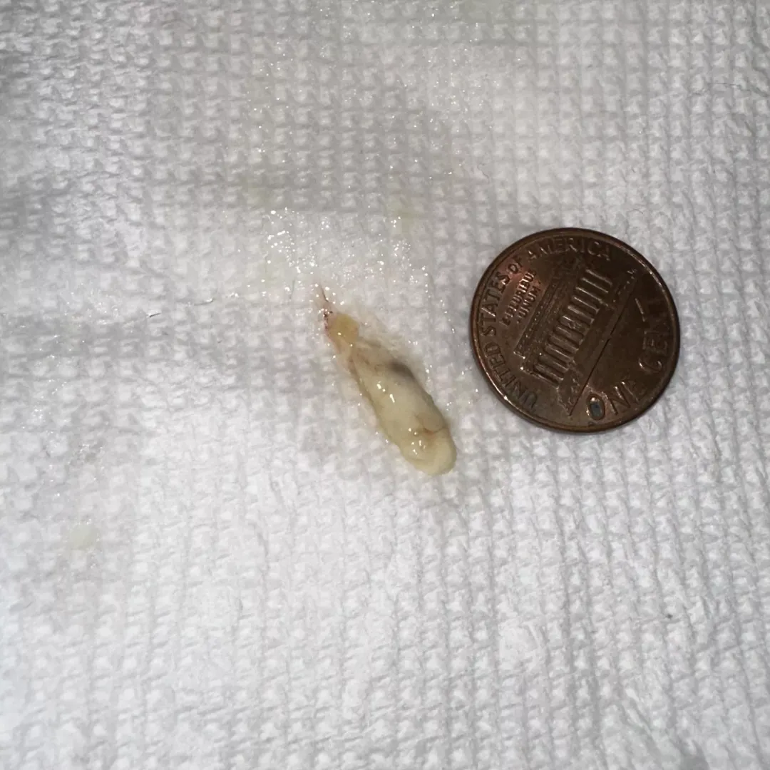 Mucus plug from a painfully blocked tear duct. Popped out into my nose following saline irrigation of the tear duct by my ophthalmologist.