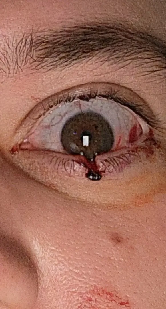 My cat cleaved open my eye