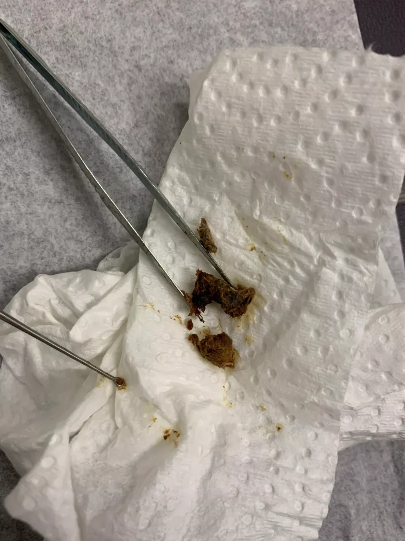 My first post. I didn’t have the courage to ask to film the extraction. The other ear had a bigger plug that was removed!