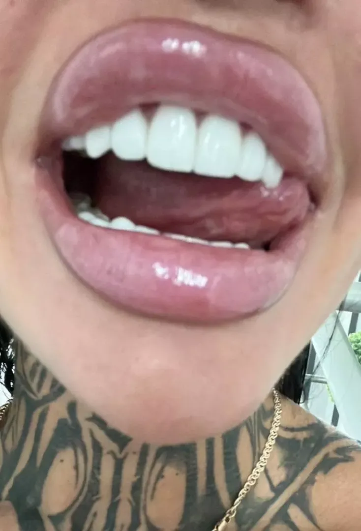 My freshly filled lips