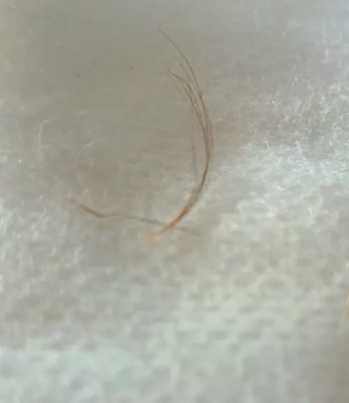 my husband pulled this tuft from my pilonidal sinus.