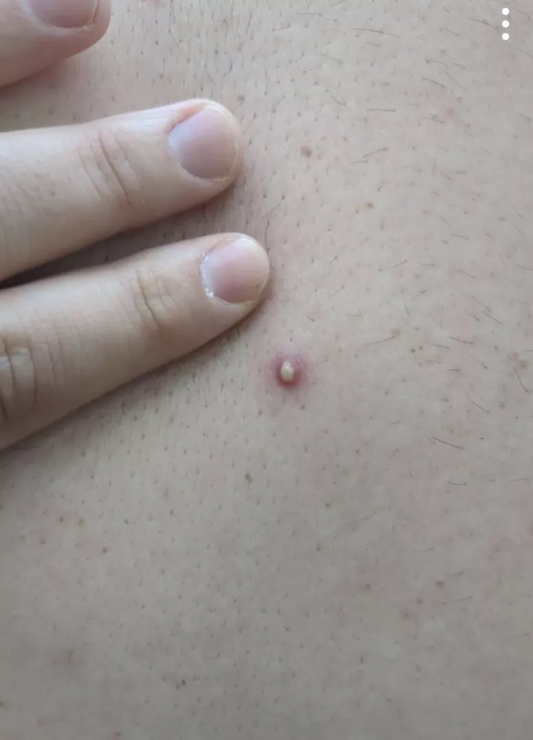 My husband said he felt something on his back, I was delighted to find this beauty. The actual pop was underwhelming, it came right out with almost no pressure and no cool explosion 😭