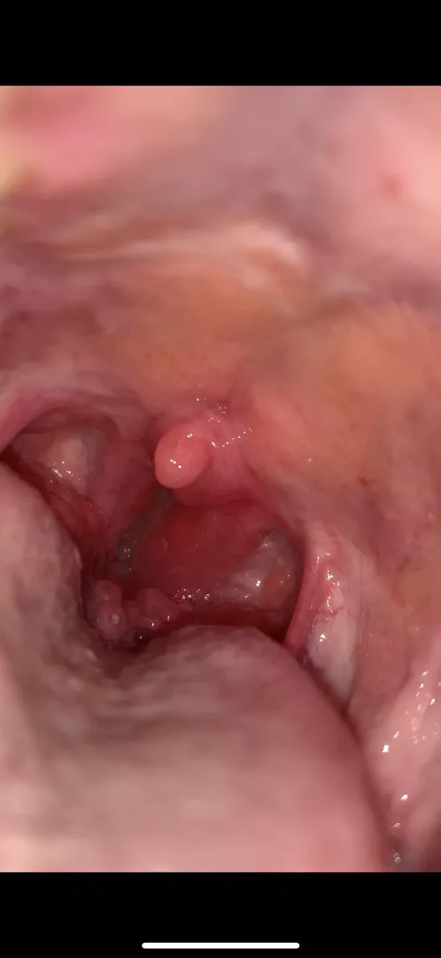Nodules in the back of my throat forbidden pop?
