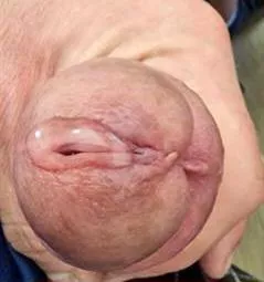 Oozing