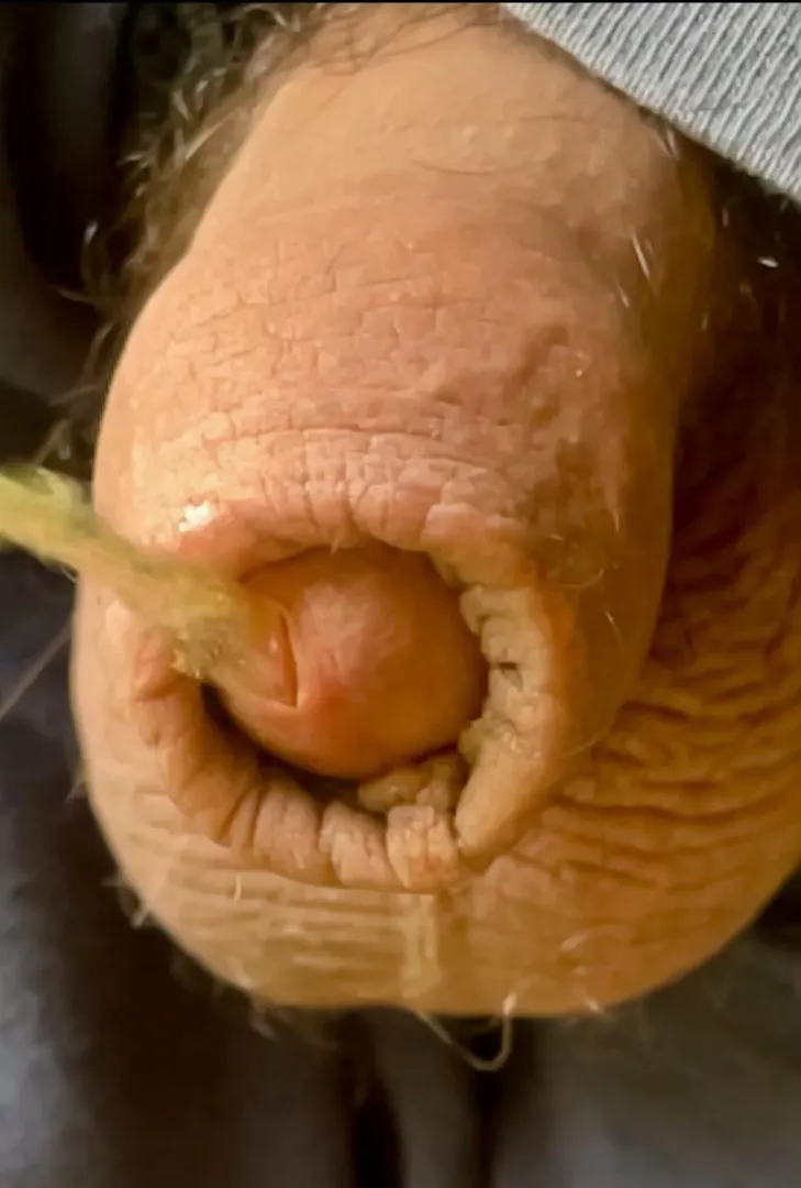 Peeing foreskin