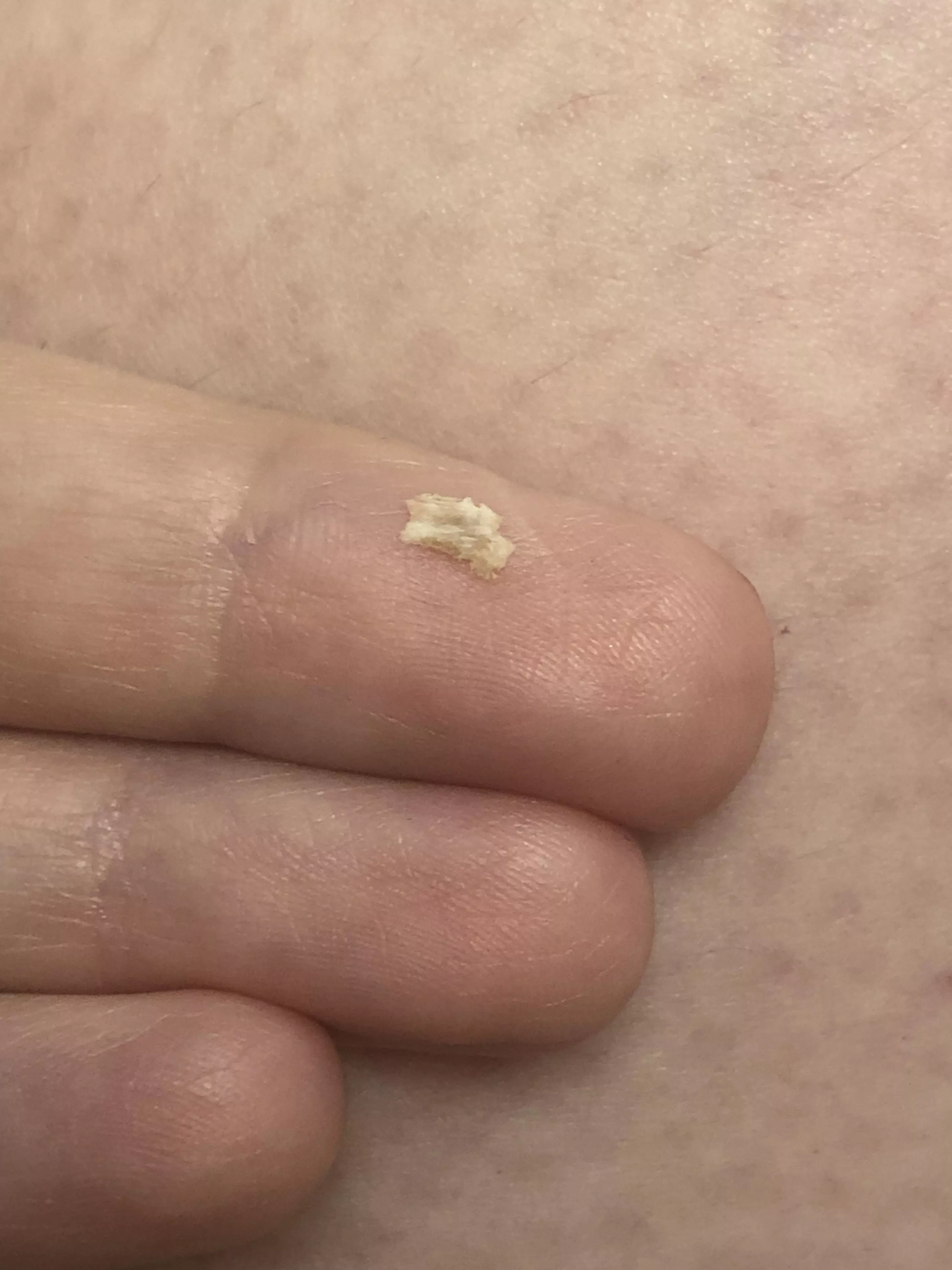 Popped this baby out of my gums this morning after wisdom tooth extraction in December