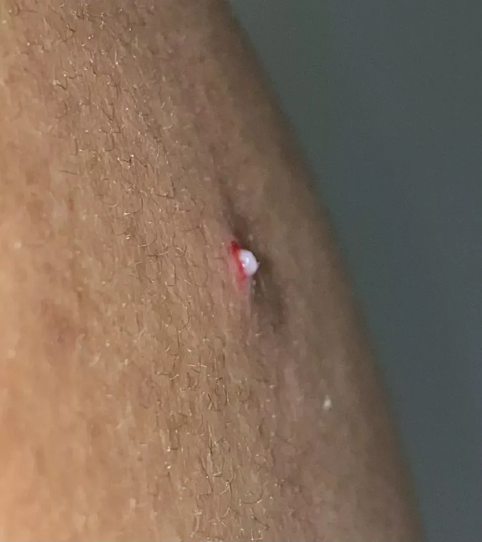 Popped this big boy on my back