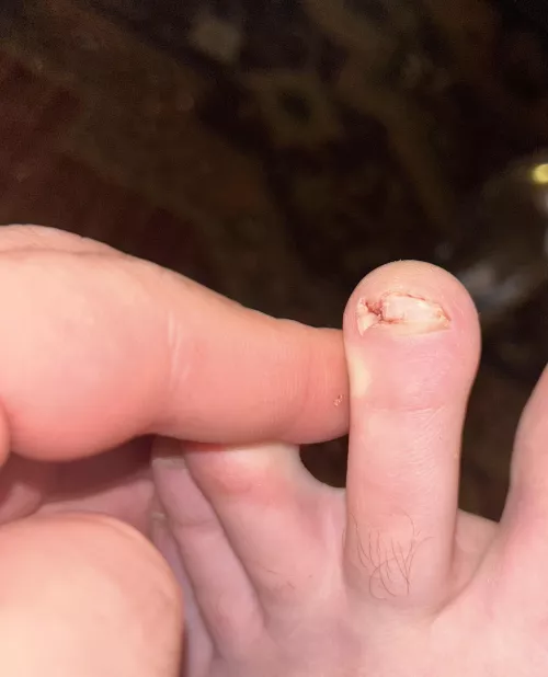 Pulled out an ingrown a couple of days ago, looks like I forgot something!