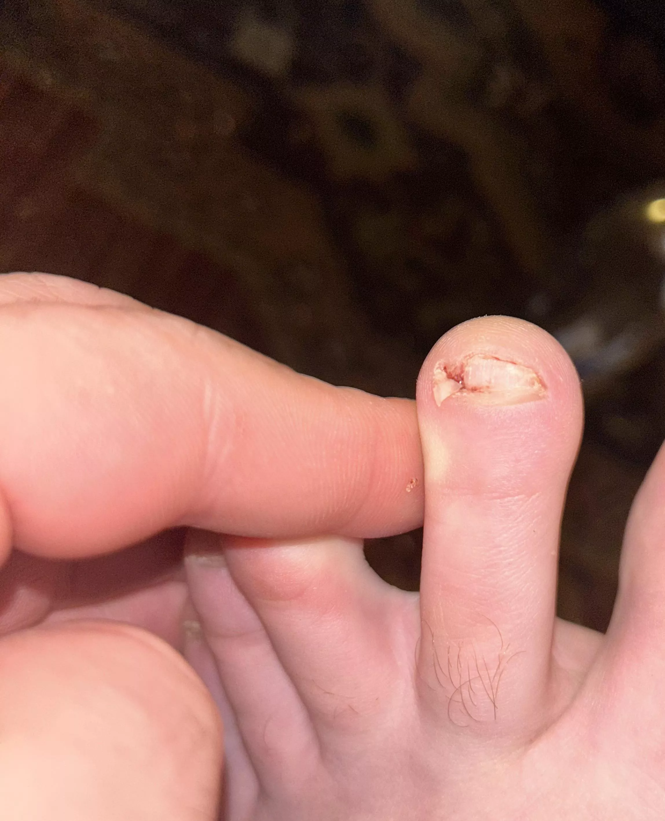 Pulled out an ingrown a couple of days ago, looks like I forgot something!
