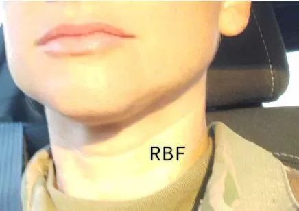 RBF