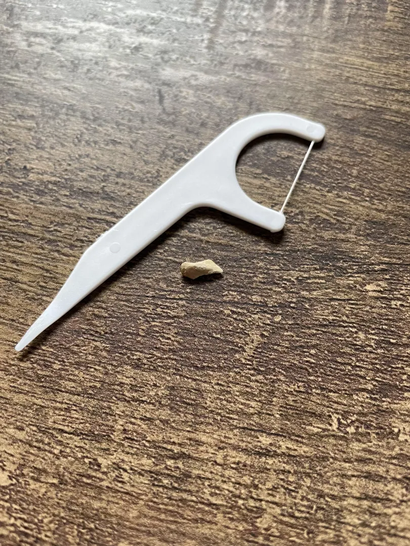 Removed this calcium buildup from behind a bottom, front tooth.