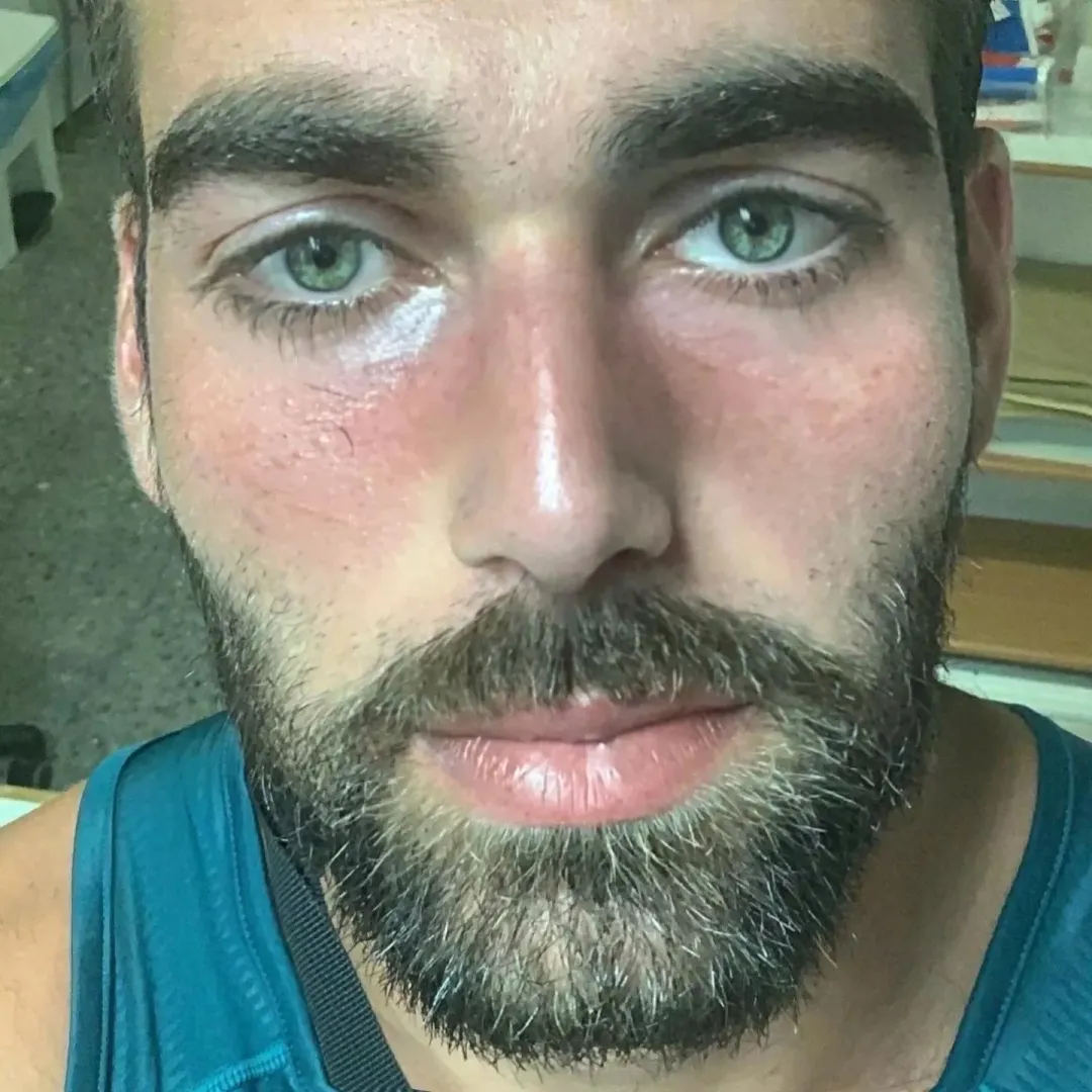 Rosacea flare-up. I struggled with this for years and am still struggling.