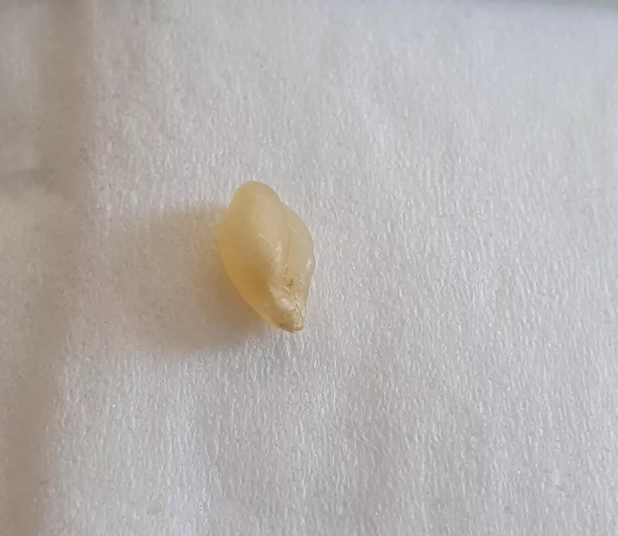 Sebaceous cyst sac just pulled from back of scalp with tweezers. I've had this thing for 10 years and it is finally gone.