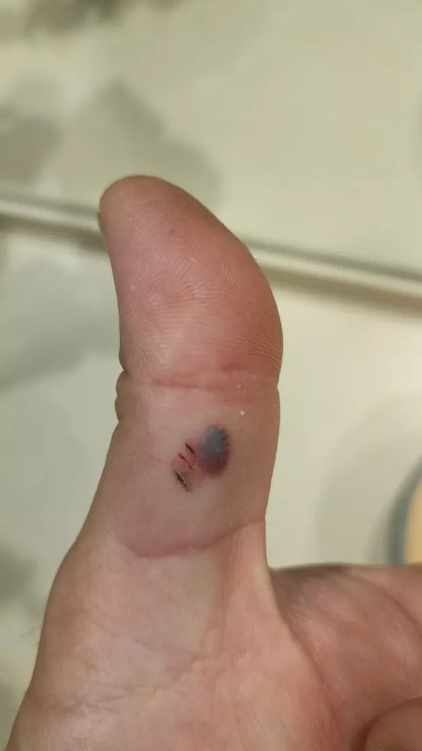 Should i pop it or wait to heal?