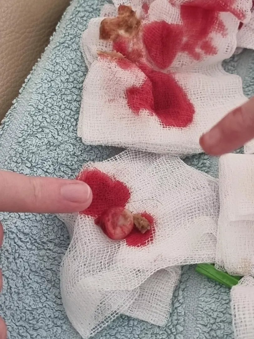 SO removed a 10 year old pilar cyst