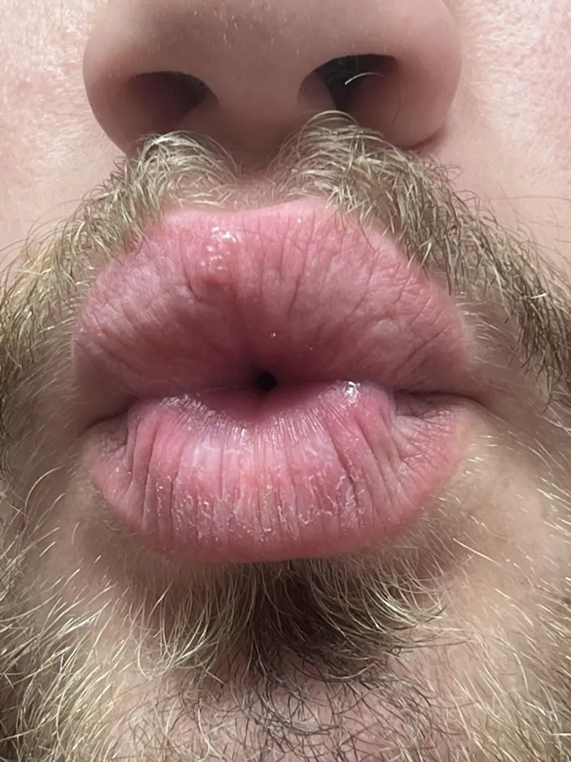 Sorry for the jump scare of a picture but wtf is on my upper lip?