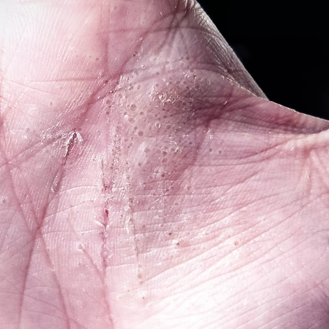 Stress related dyshidrosis is my webMD guess
