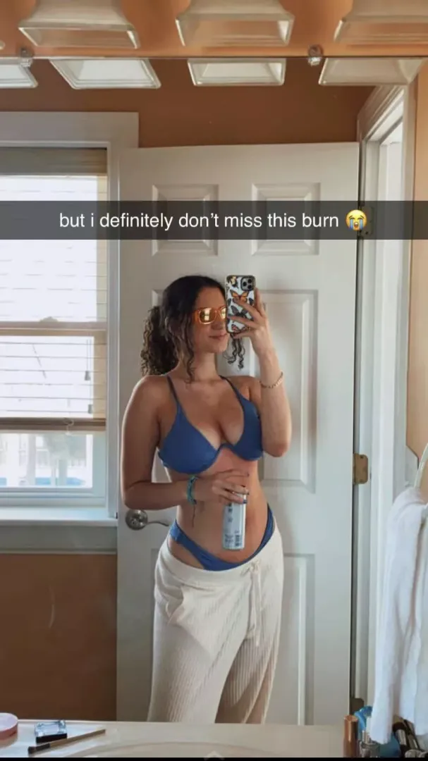 Sun burnt