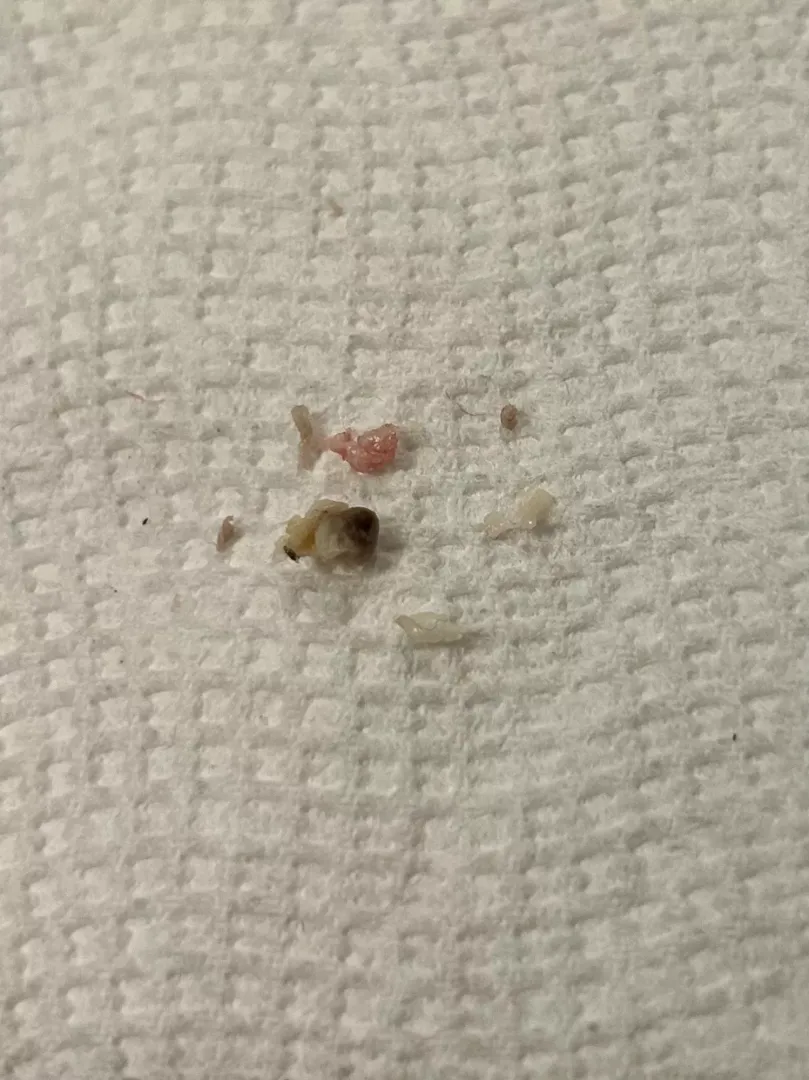 The grody results of what I thought was a regular pimple on my inner thigh from chafing! Wish I'd thought to record the very bloody cyst pop 🍾