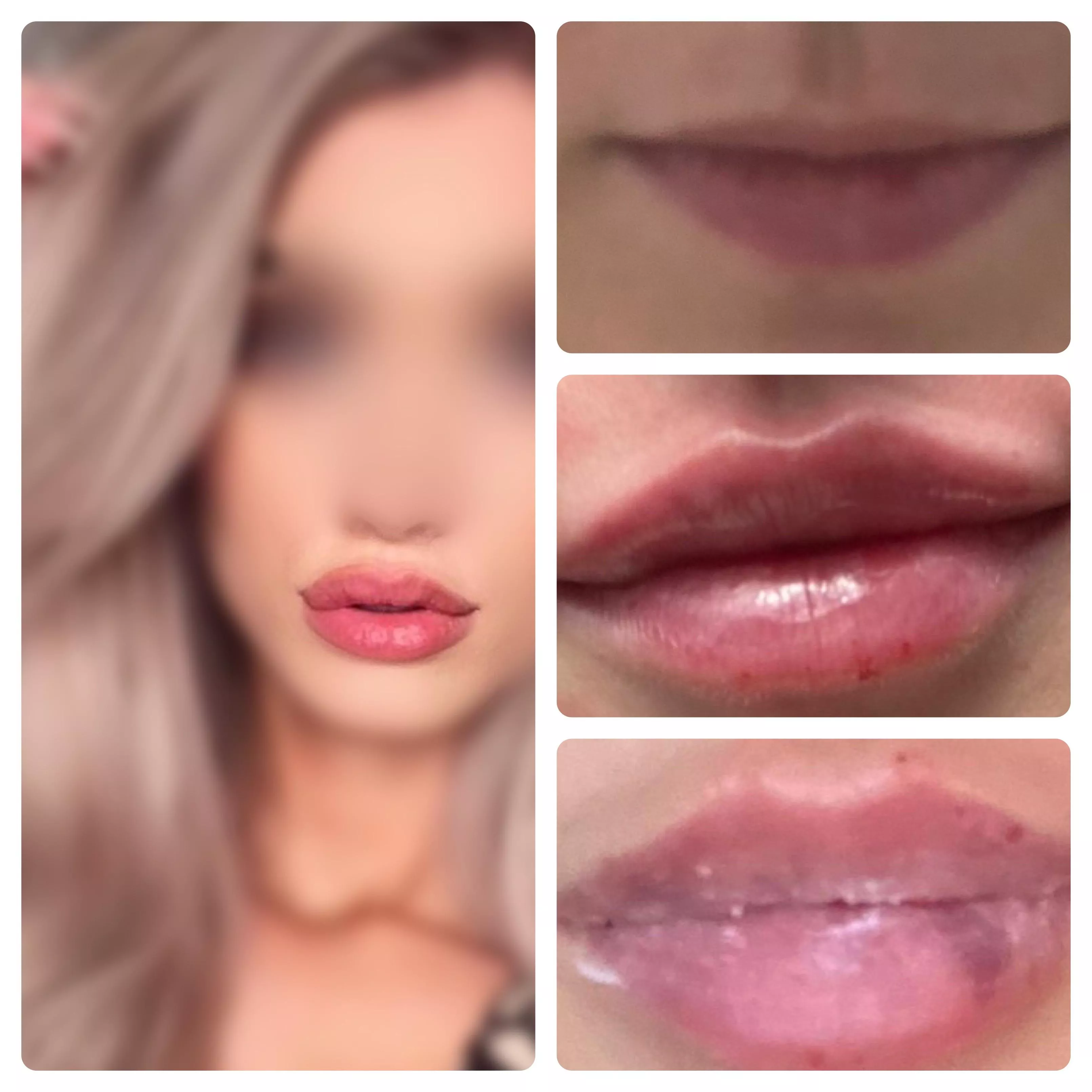 Third round of lip fillers booked! Hoping for the perfect bimbo pout!