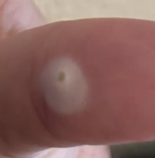 This wart on my thumb looks super poppable but can’t(I’ve tried) it’s white because the wart remover bandaids I put on it