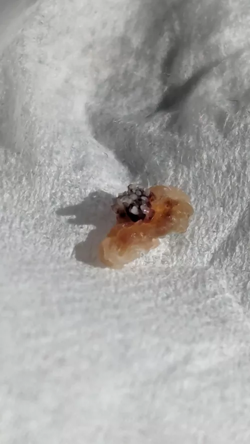 This wart that fell off my face after being frozen looks like a Nudibranch