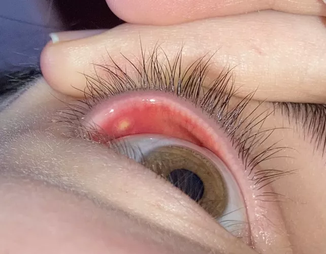Today I learned the hard way what an inner stye is.