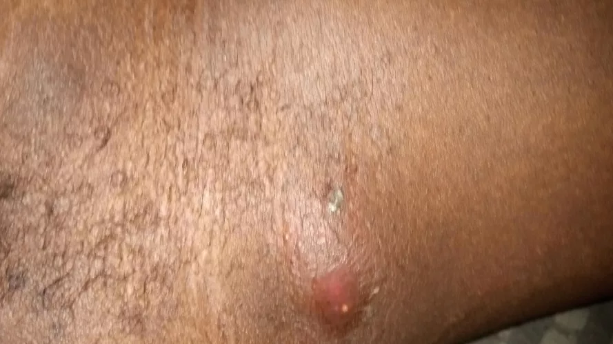 Underarm going to hospital later tonight