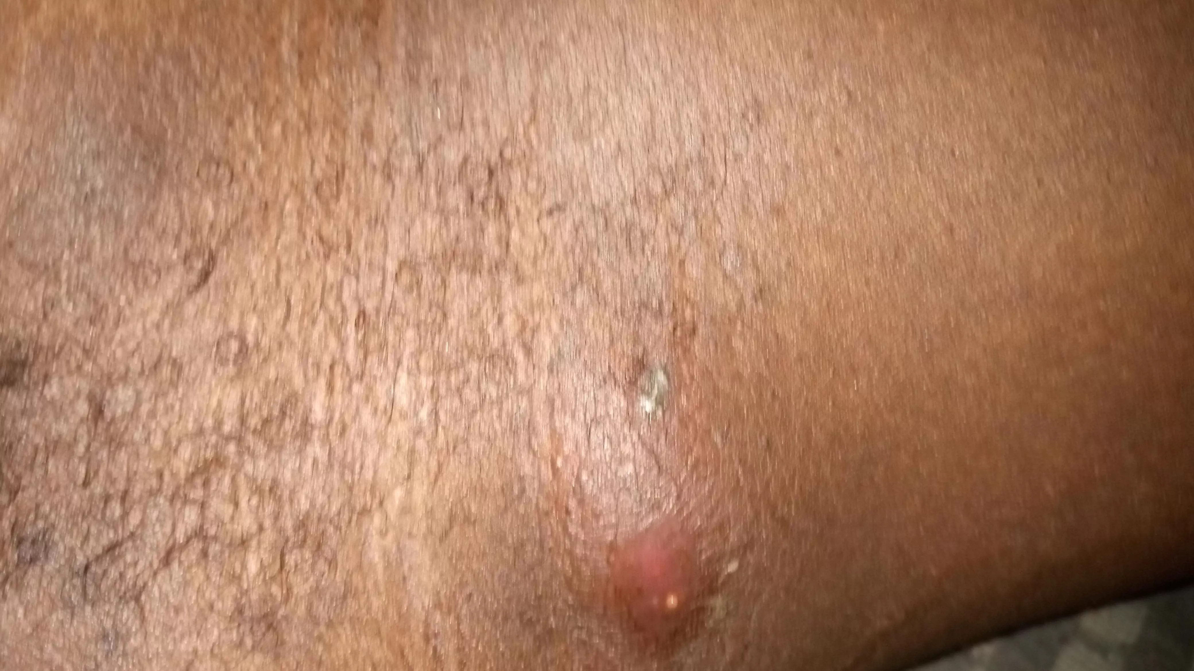 Underarm going to hospital later tonight