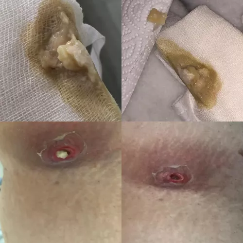 update from yesterday’s post, the big chunks came out when i removed the bandage this morning and i am left with a hole that keeps draining