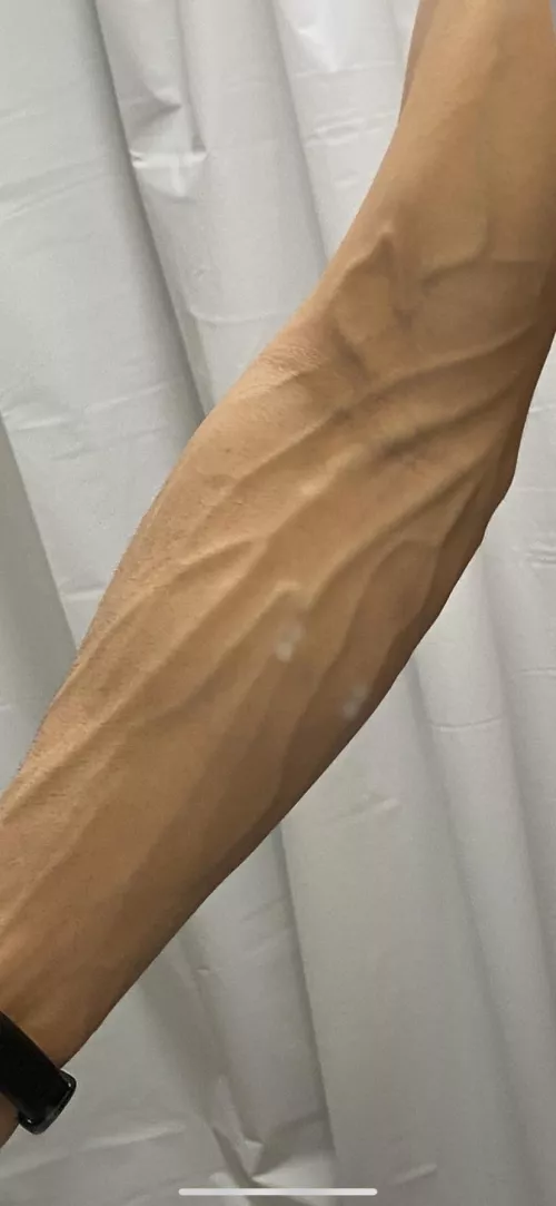 veins on veins 🩸