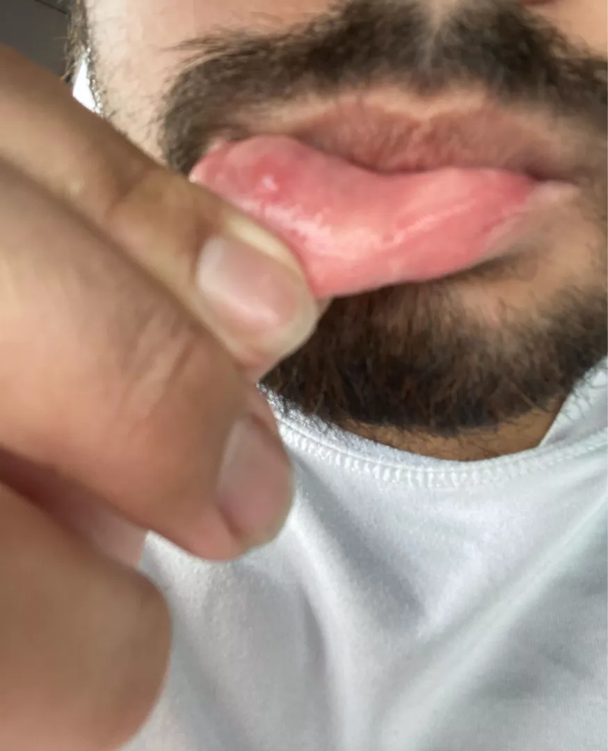 Werid bump on lip I have a habit of biting lip at work but doesn’t look like a Oral Mucocele it’s very white