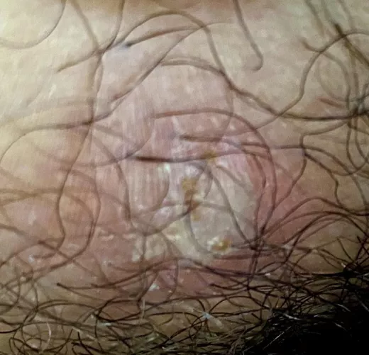 What is this on my groin and what should I do?