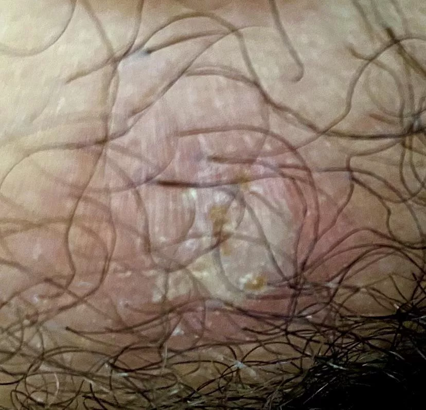 What is this on my groin and what should I do?