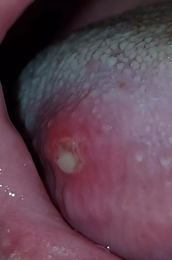 What is this spot on my tounge? It's been driving me crazy since saturday!